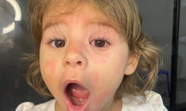 Alergia Alimentar Grave: Uma história de superação, conscientização e muito amor